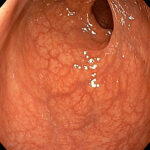 rectum image colonoscopy sydney