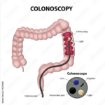 Diagram of colonoscopy and colonoscope